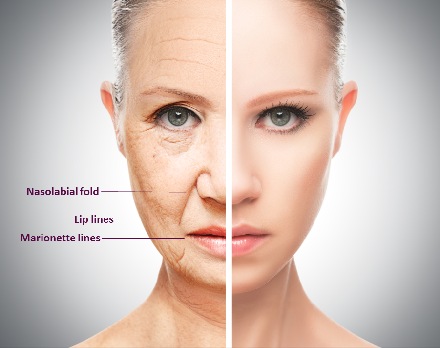 Dermal Fillers