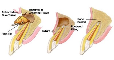 Apicoectomy