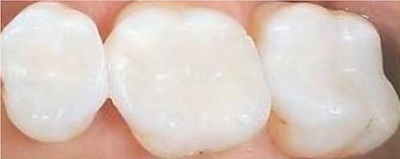 Dental Filling