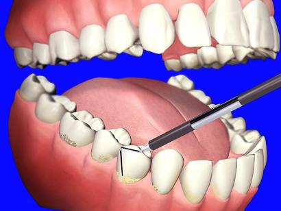 Dental Prophylaxis
